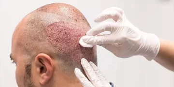  آزمایشات لازم قبل از کاشت مو