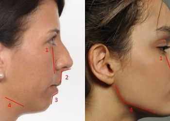 زاویه سازی فک با تزریق بوتاکس