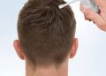 درمان ریزش مو در مردان