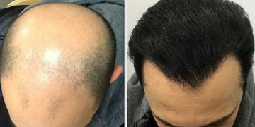 کاشت مو به روش میکروگرافت