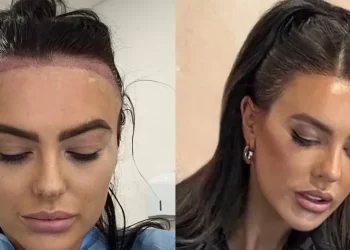 کاشت مو زنان پیشانی بلند به چه صورت است؟