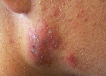 همه‌چیز درباره جوش کیستی یا آکنه کیستیک